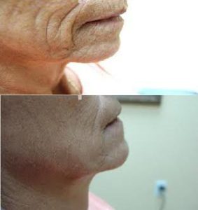 collagen induction therapy, omaha